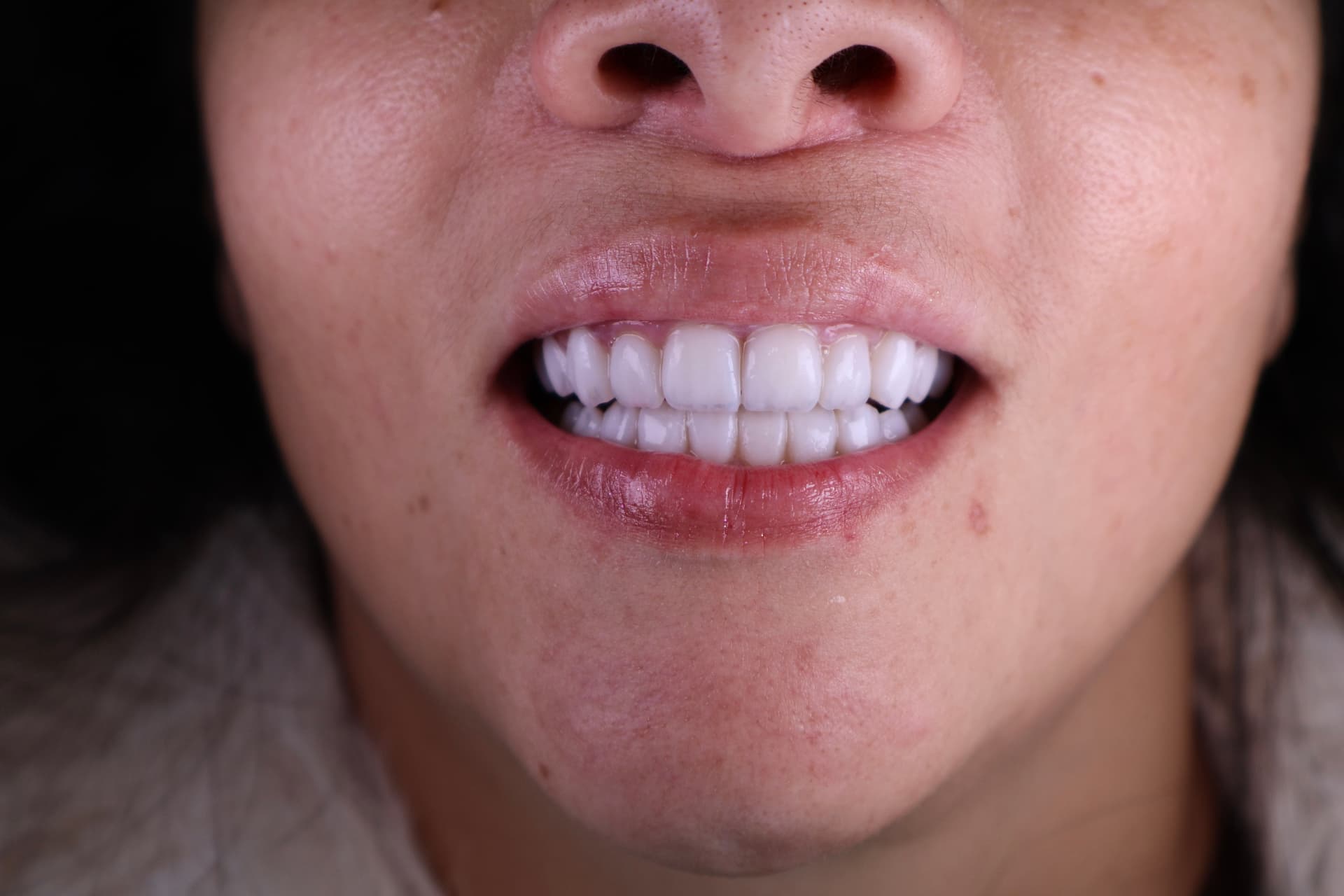 Caso 02 — sorriso após lentes híbridas