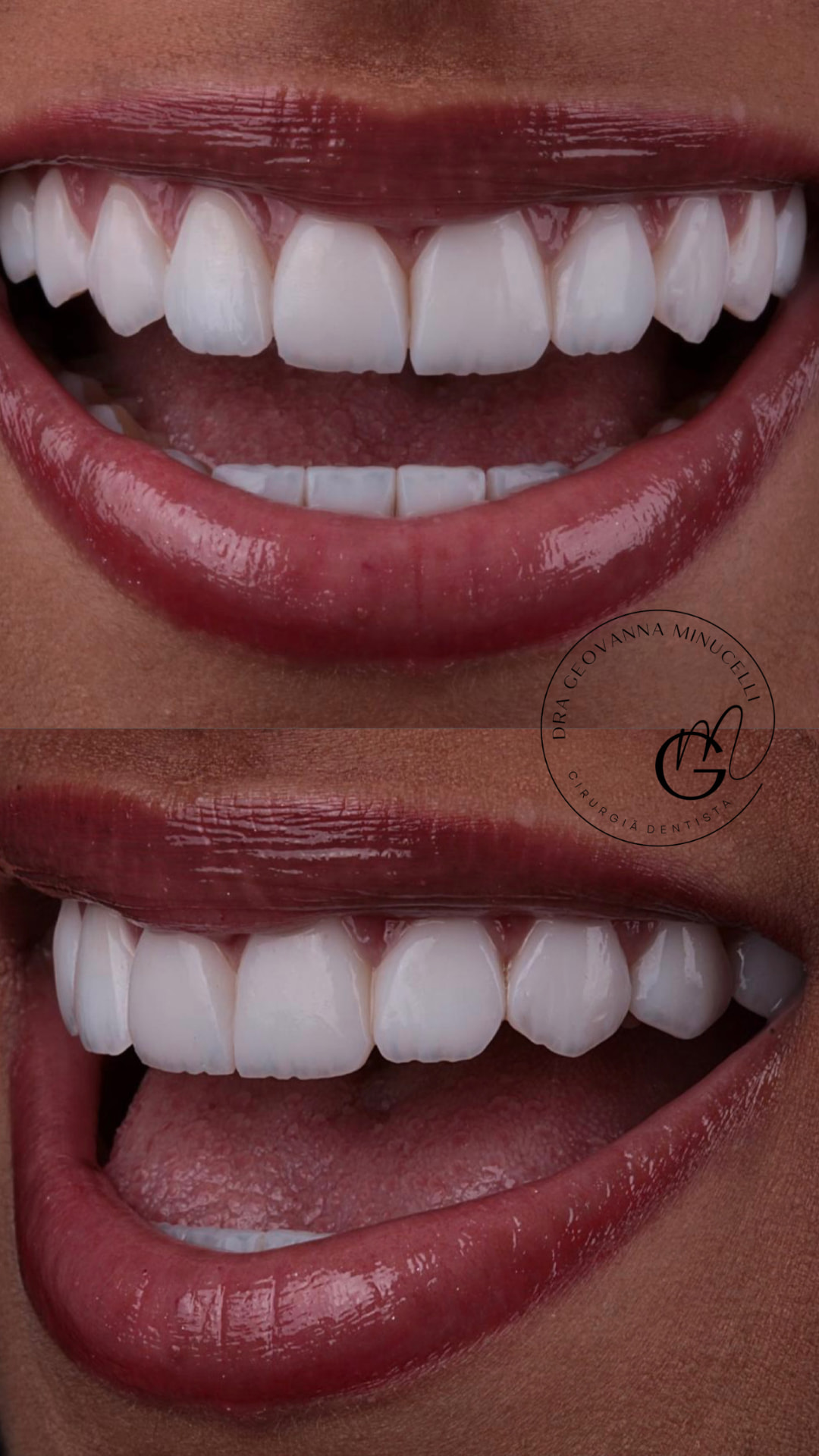 Antes e depois de lentes híbridas — sorriso natural da paciente