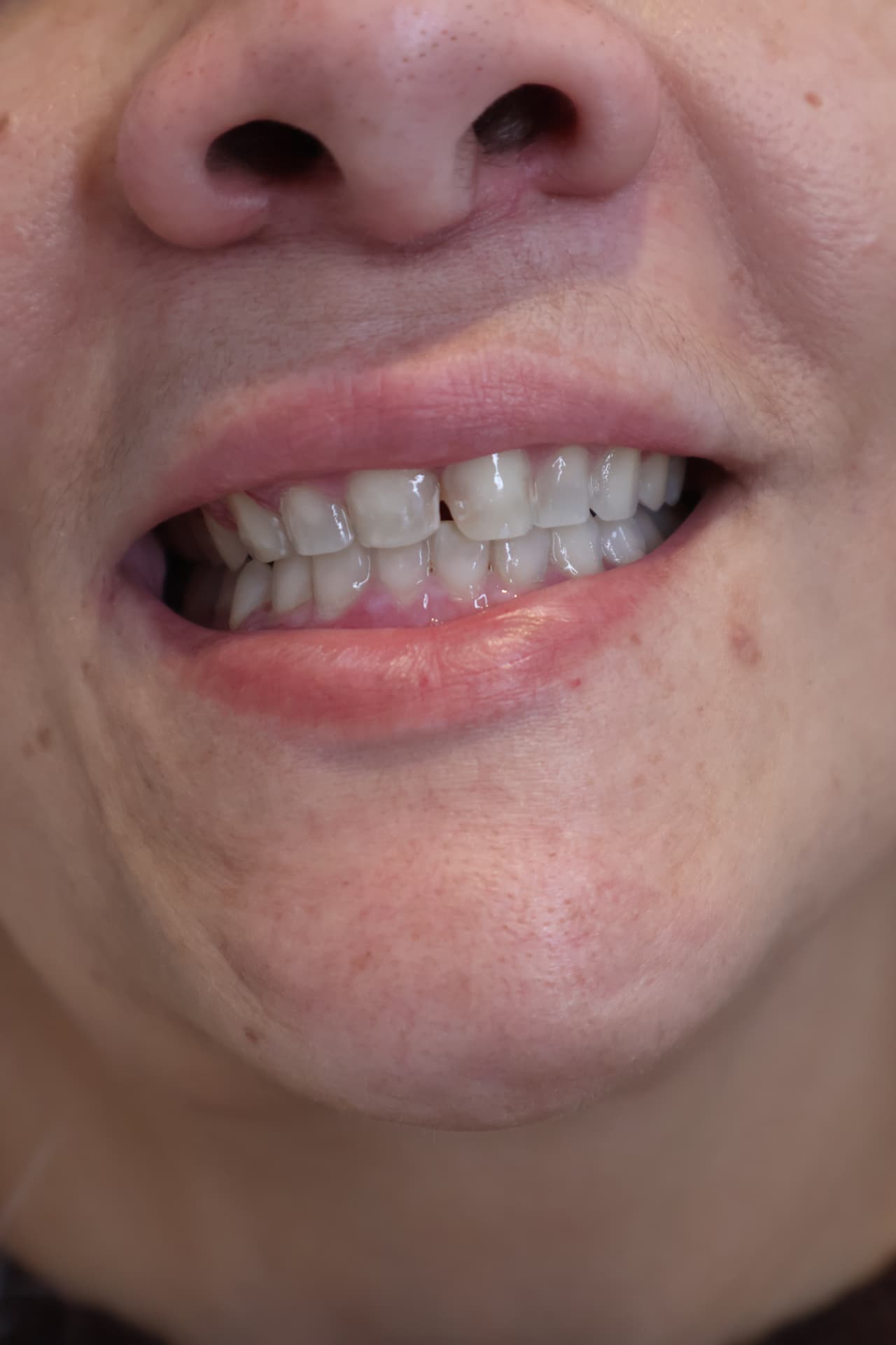 Caso 02 — sorriso antes do tratamento