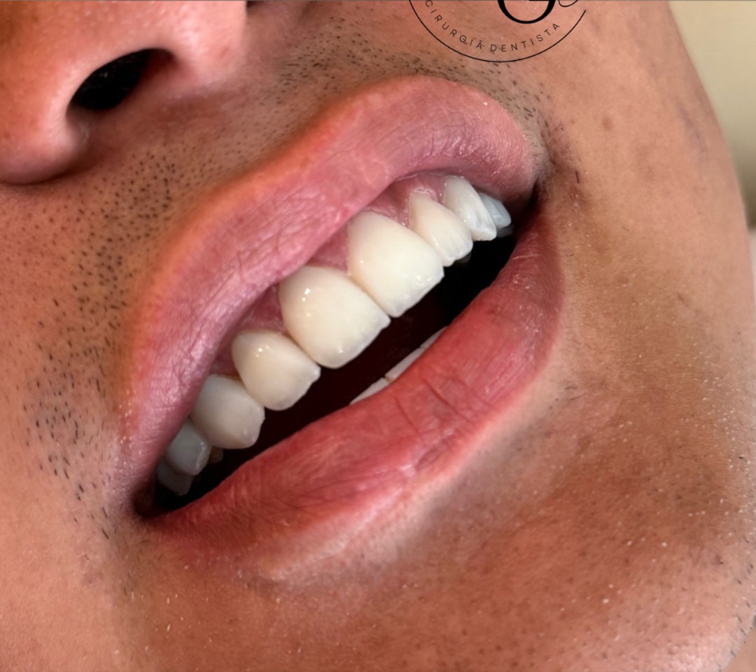 Caso 01 — sorriso após lentes híbridas