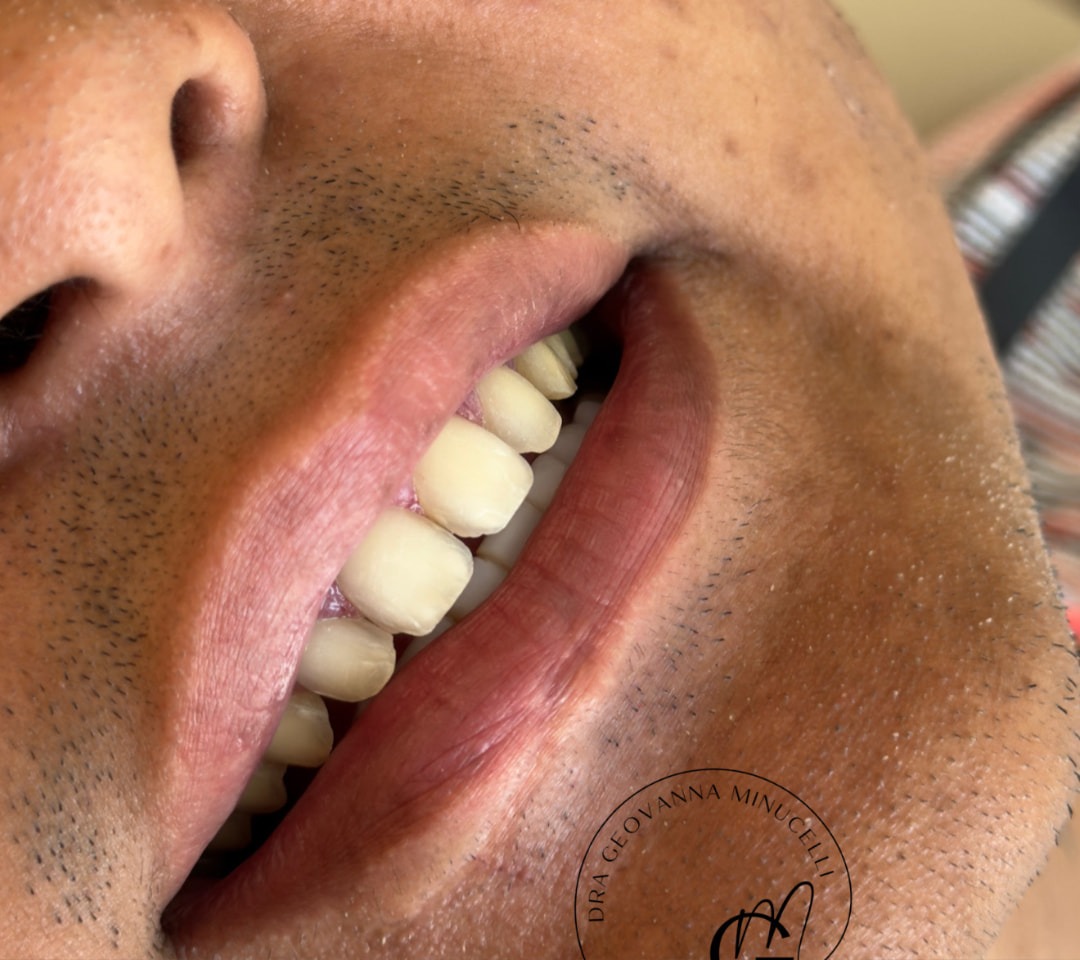 Caso 01 — sorriso antes do tratamento